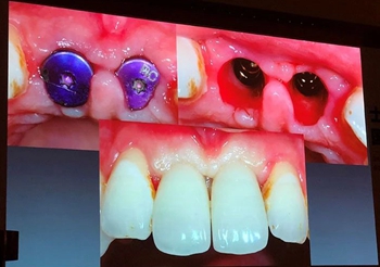 課堂筆記 | 看大師如何運(yùn)用數(shù)字化流程解決復(fù)雜病例 課堂筆記 | 看大師如何運(yùn)用數(shù)字化流程解決復(fù)雜病例