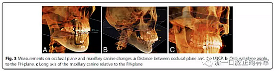 正畸文獻(xiàn)閱讀--用舌側(cè)滑動(dòng)牽引系統(tǒng)控制前牙區(qū)段:初步的CBCT研究 正畸文獻(xiàn)閱讀--用舌側(cè)滑動(dòng)牽引系統(tǒng)控制前牙區(qū)段:初步的CBCT研究