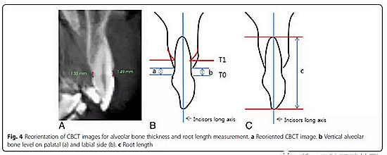 正畸文獻(xiàn)閱讀--用舌側(cè)滑動(dòng)牽引系統(tǒng)控制前牙區(qū)段:初步的CBCT研究 正畸文獻(xiàn)閱讀--用舌側(cè)滑動(dòng)牽引系統(tǒng)控制前牙區(qū)段:初步的CBCT研究