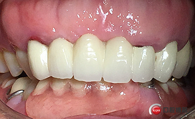 上前牙骨量不足種植+信封式植骨(梁光強) 上前牙骨量不足種植+信封式植骨(梁光強)