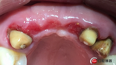 上前牙骨量不足種植+信封式植骨(梁光強) 上前牙骨量不足種植+信封式植骨(梁光強)