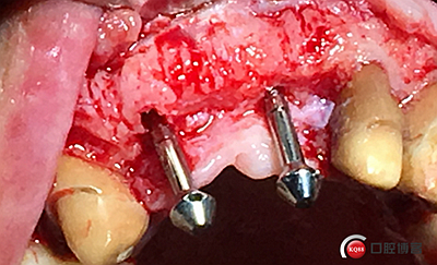 上前牙骨量不足種植+信封式植骨(梁光強) 上前牙骨量不足種植+信封式植骨(梁光強)