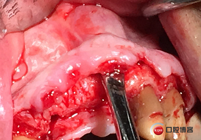 上前牙骨量不足種植+信封式植骨(梁光強) 上前牙骨量不足種植+信封式植骨(梁光強)