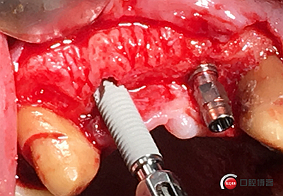 上前牙骨量不足種植+信封式植骨(梁光強) 上前牙骨量不足種植+信封式植骨(梁光強)