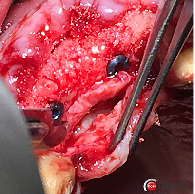 上前牙骨量不足種植+信封式植骨(梁光強) 上前牙骨量不足種植+信封式植骨(梁光強)