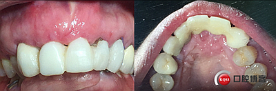 上前牙骨量不足種植+信封式植骨(梁光強) 上前牙骨量不足種植+信封式植骨(梁光強)