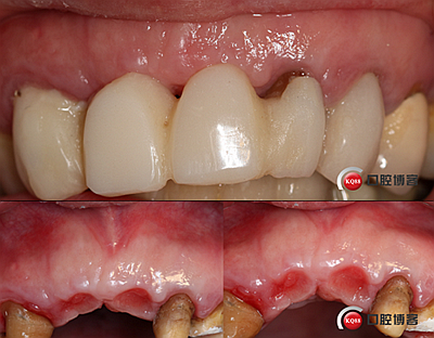 上前牙骨量不足種植+信封式植骨(梁光強) 上前牙骨量不足種植+信封式植骨(梁光強)