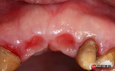 上前牙骨量不足種植+信封式植骨(梁光強) 上前牙骨量不足種植+信封式植骨(梁光強)
