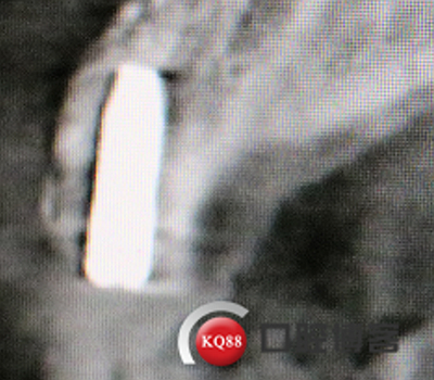 上前牙骨量不足種植+信封式植骨(梁光強) 上前牙骨量不足種植+信封式植骨(梁光強)