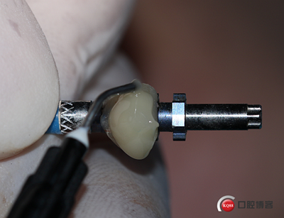 上前牙骨量不足種植+信封式植骨(梁光強) 上前牙骨量不足種植+信封式植骨(梁光強)