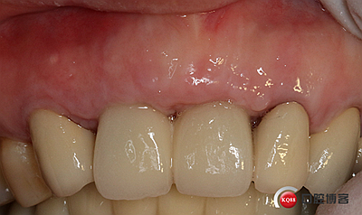 上前牙骨量不足種植+信封式植骨(梁光強) 上前牙骨量不足種植+信封式植骨(梁光強)