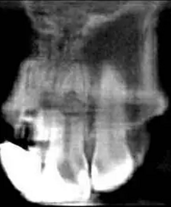 伴隨根管內(nèi)鈣化物形成牙根內(nèi)吸收治療1例 伴隨根管內(nèi)鈣化物形成牙根內(nèi)吸收治療1例