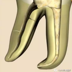 知識分享:根管治療的標(biāo)準(zhǔn)步驟 知識分享:根管治療的標(biāo)準(zhǔn)步驟
