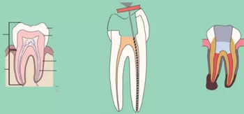 知識分享:根管治療的標(biāo)準(zhǔn)步驟 知識分享:根管治療的標(biāo)準(zhǔn)步驟