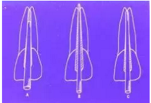 知識分享:根管治療的標(biāo)準(zhǔn)步驟 知識分享:根管治療的標(biāo)準(zhǔn)步驟