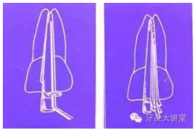 知識分享:根管治療的標(biāo)準(zhǔn)步驟 知識分享:根管治療的標(biāo)準(zhǔn)步驟