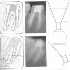 知識分享:根管治療的標(biāo)準(zhǔn)步驟 知識分享:根管治療的標(biāo)準(zhǔn)步驟