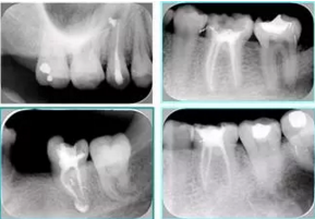 知識分享:根管治療的標(biāo)準(zhǔn)步驟 知識分享:根管治療的標(biāo)準(zhǔn)步驟
