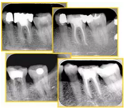知識分享:根管治療的標(biāo)準(zhǔn)步驟 知識分享:根管治療的標(biāo)準(zhǔn)步驟