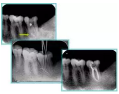 知識分享:根管治療的標(biāo)準(zhǔn)步驟 知識分享:根管治療的標(biāo)準(zhǔn)步驟