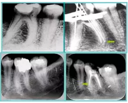 知識分享:根管治療的標(biāo)準(zhǔn)步驟 知識分享:根管治療的標(biāo)準(zhǔn)步驟