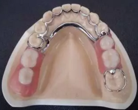 活動義齒的注意事項有哪些 活動義齒的注意事項有哪些