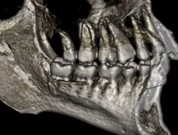 正畸文獻(xiàn)賞析--CBCT在正畸中的廣泛應(yīng)用 正畸文獻(xiàn)賞析--CBCT在正畸中的廣泛應(yīng)用