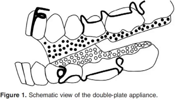 正畸文獻賞析--活動矯治器在III類患者中的應(yīng)用 正畸文獻賞析--活動矯治器在III類患者中的應(yīng)用
