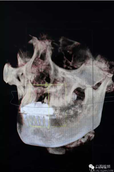 【原創(chuàng)博客】烤瓷橋下的悲劇-張東星 【原創(chuàng)博客】烤瓷橋下的悲劇-張東星