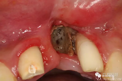 【原創(chuàng)博客】烤瓷橋下的悲劇-張東星 【原創(chuàng)博客】烤瓷橋下的悲劇-張東星