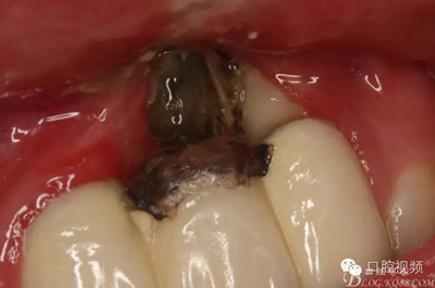 【原創(chuàng)博客】烤瓷橋下的悲劇-張東星 【原創(chuàng)博客】烤瓷橋下的悲劇-張東星