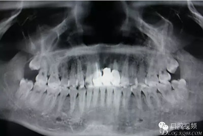 【原創(chuàng)博客】烤瓷橋下的悲劇-張東星 【原創(chuàng)博客】烤瓷橋下的悲劇-張東星