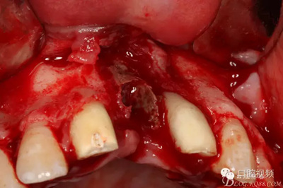 【原創(chuàng)博客】烤瓷橋下的悲劇-張東星 【原創(chuàng)博客】烤瓷橋下的悲劇-張東星