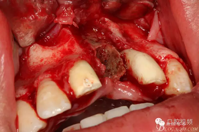 【原創(chuàng)博客】烤瓷橋下的悲劇-張東星 【原創(chuàng)博客】烤瓷橋下的悲劇-張東星