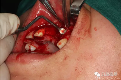 【原創(chuàng)博客】烤瓷橋下的悲劇-張東星 【原創(chuàng)博客】烤瓷橋下的悲劇-張東星