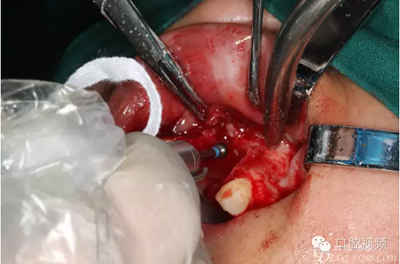 【原創(chuàng)博客】烤瓷橋下的悲劇-張東星 【原創(chuàng)博客】烤瓷橋下的悲劇-張東星