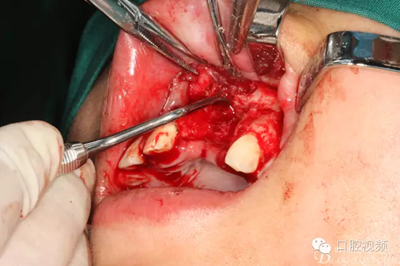 【原創(chuàng)博客】烤瓷橋下的悲劇-張東星 【原創(chuàng)博客】烤瓷橋下的悲劇-張東星