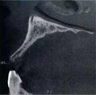 CBCT在種植中應(yīng)用&mdash;&mdash;上頜篇