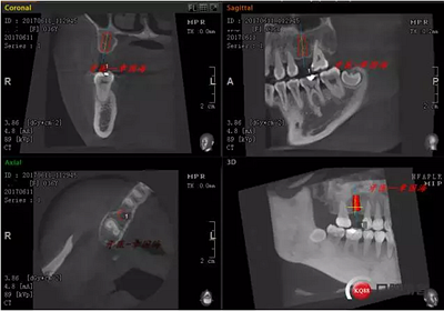 種植導板制作 種植導板制作