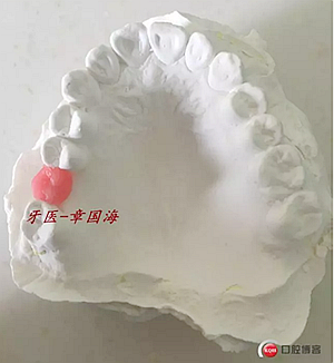 種植導板制作 種植導板制作