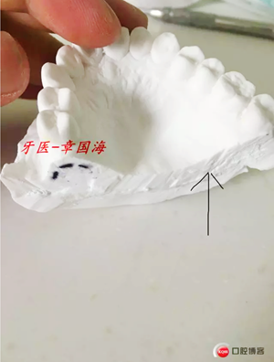 種植導板制作 種植導板制作