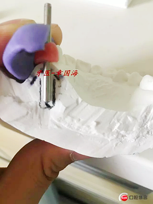 種植導板制作 種植導板制作