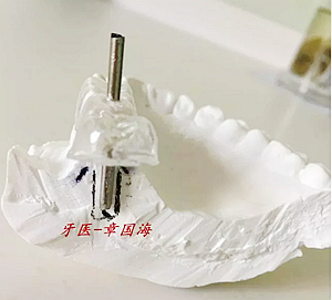 種植導板制作 種植導板制作