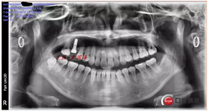 種植導板制作 種植導板制作