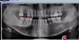 種植導板制作 種植導板制作