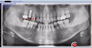 種植導板制作 種植導板制作