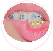 牙齒矯正，為什么要掛橡皮筋？