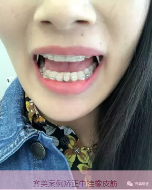 牙齒矯正，為什么要掛橡皮筋？