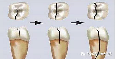 成人牙齒外傷了怎么應急處理？