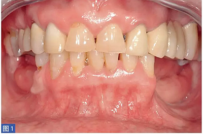 柵欄技術(shù)用于局部三維骨增量 &mdash;技術(shù)概述與病例匯報 （1）